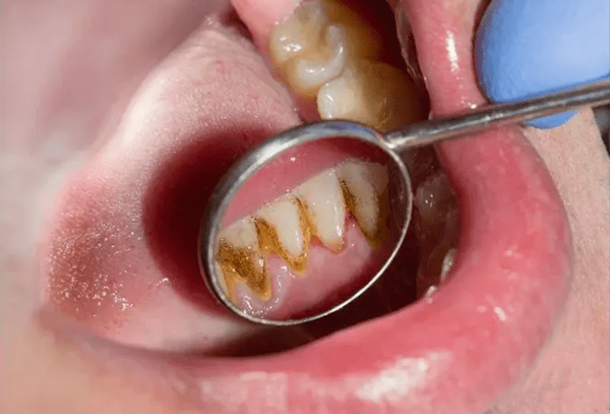 食物残渣唰唰排出来,牙缝干净了,口臭没了,拥有一口好牙~_牙齿_口腔