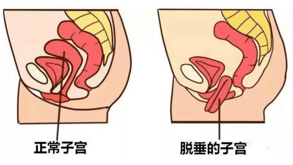 关爱女性 关注盆底健康_肌肉_康复_子宫