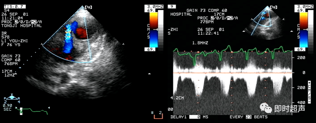 心肌梗死常见并发症超声诊断_二尖瓣_心动图_运动
