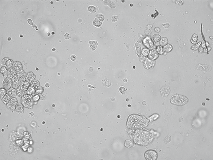 最新资料整理的尿检图谱:33张图片展示尿液中的上皮细胞_chew_来自