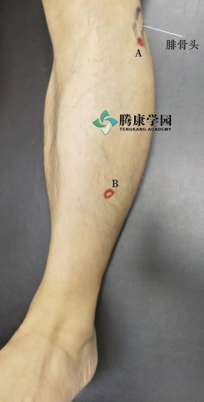 导致"行路难"的腓总神经卡压综合征_腓骨_治疗_检查