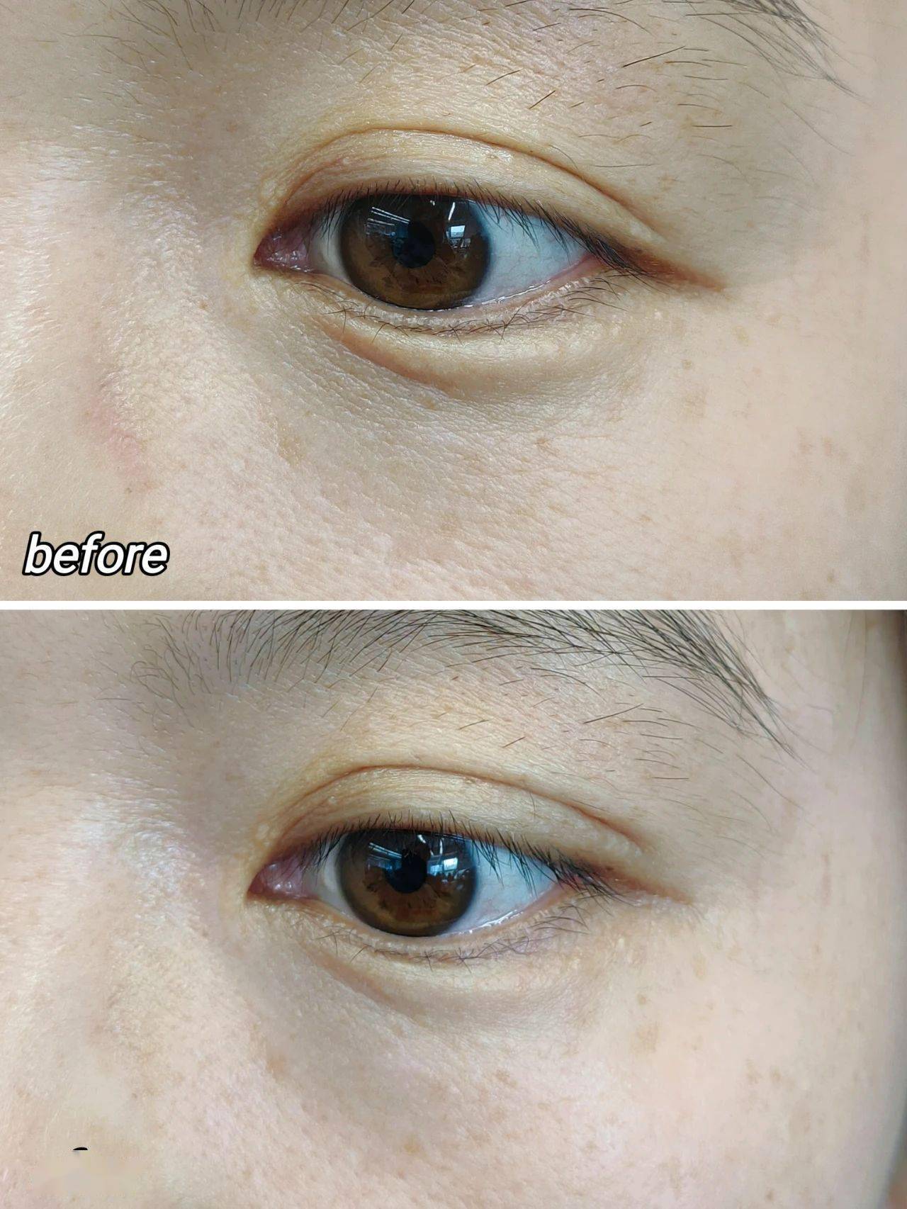 不管你是眼皮子天生就松,年纪大了缺少胶原蛋白,眼尾下垂,眯眯眼