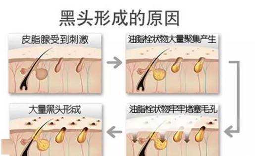 黑头里挤出来的东西是什么鬼？插图1