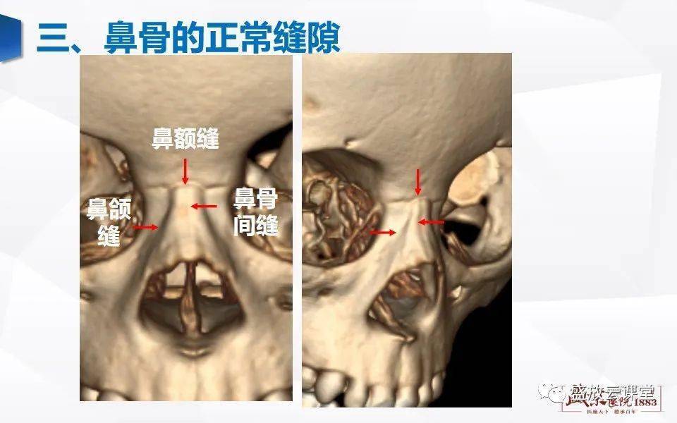 鼻骨三维ct图像图片