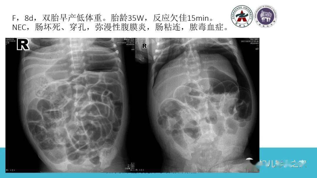新生儿坏死性小肠结肠炎