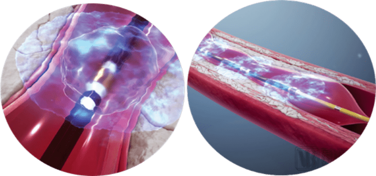 shockwave的产品作用于血管示意图在治疗效果上,shock