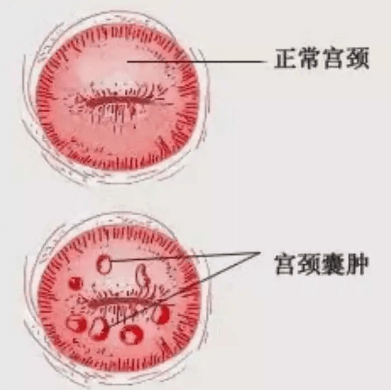 宫颈上的青春痘——宫颈囊肿,让你一听害怕的病症,其实……