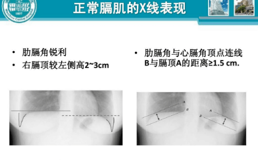 膈膨升图片