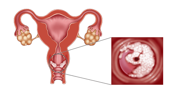 宫颈癌褐色分泌物早期图片