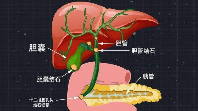 手术切除胆囊