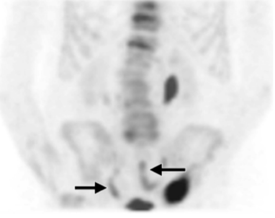 真正的骨转移瘤不是靠骨扫描发现的,而是它……_箭头_显示_图像