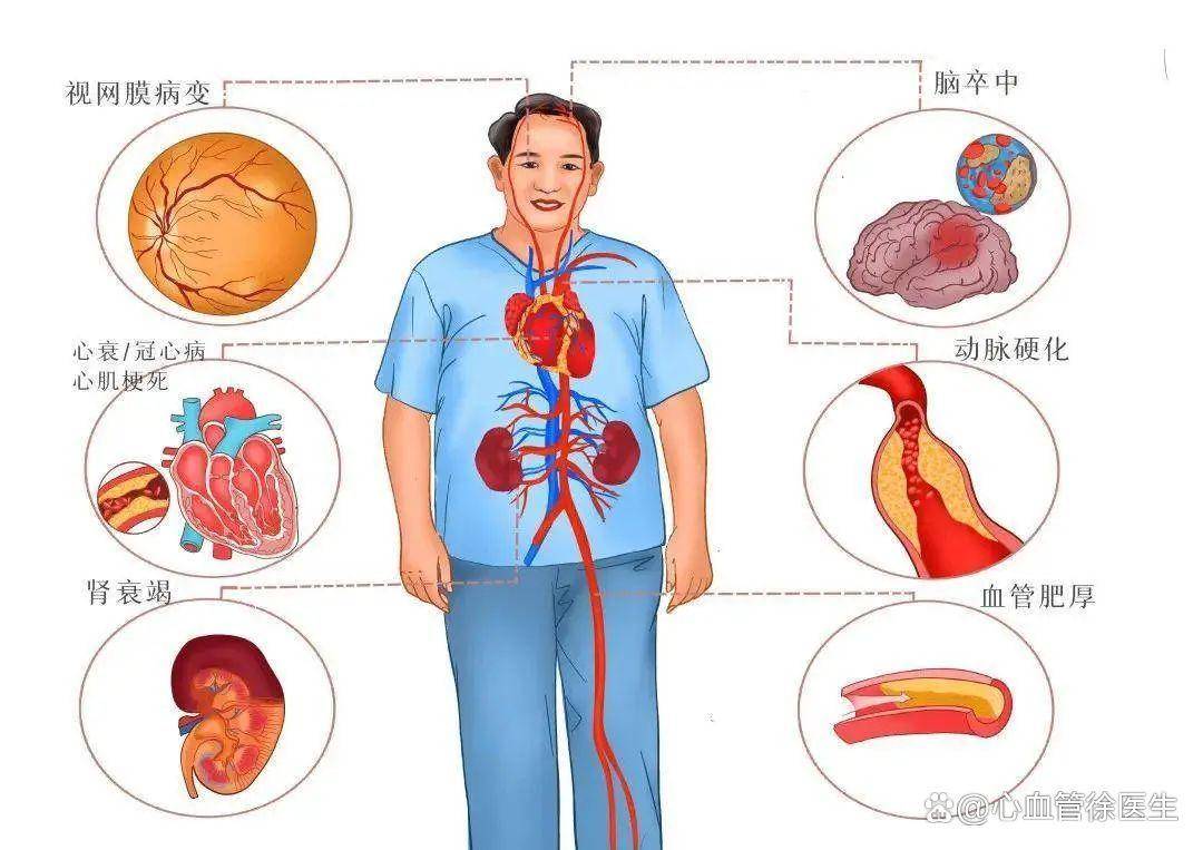 如何判断是否出现了高血压并发症:靶器官损害_检查_心脏_患者