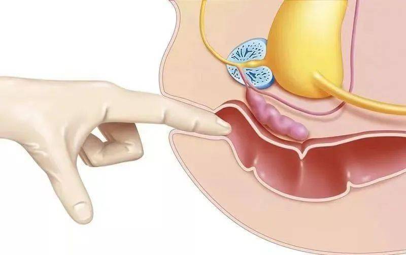 "一指禅功"解"便"利【全面深化优质服务】_患者_操作_直肠