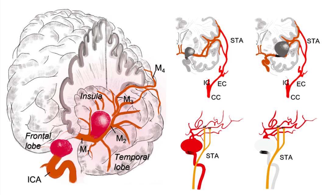 脑动脉瘤介入治疗图解图片