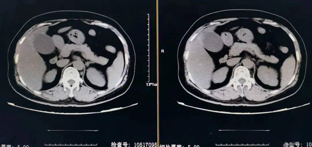 诡异的转移性右下腹痛,不是阑尾炎?原因竟是……_患者_腹部_复查