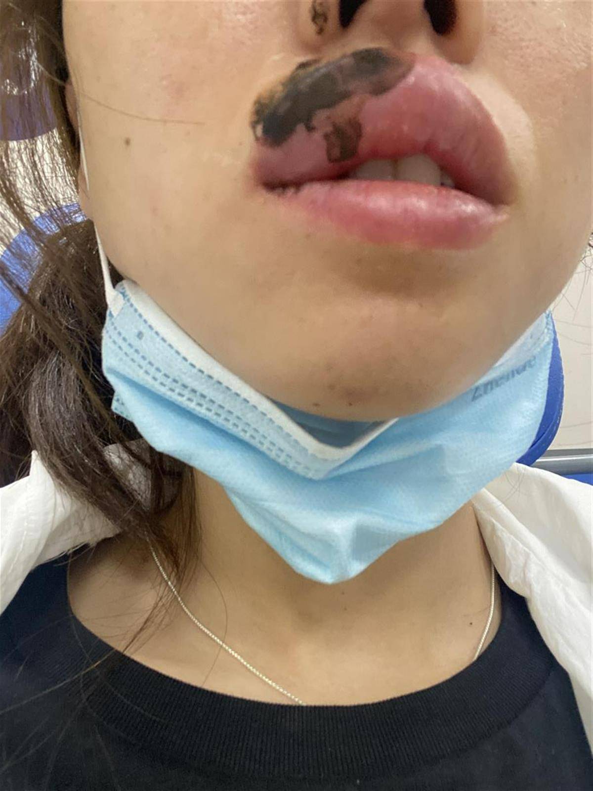 女子睡梦中嘴被蜈蚣咬肿成"香肠",医生:可用肥皂水冲洗_承女士_蔡翔