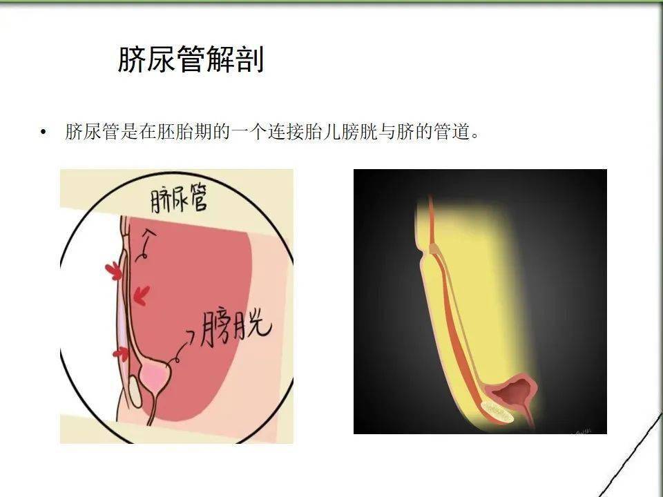 脐尿管囊肿手术后图片图片