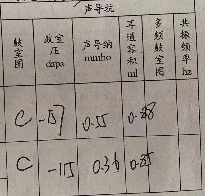 声导抗检查结果显示c型图,鼓室负压,考虑鼓室有积液.