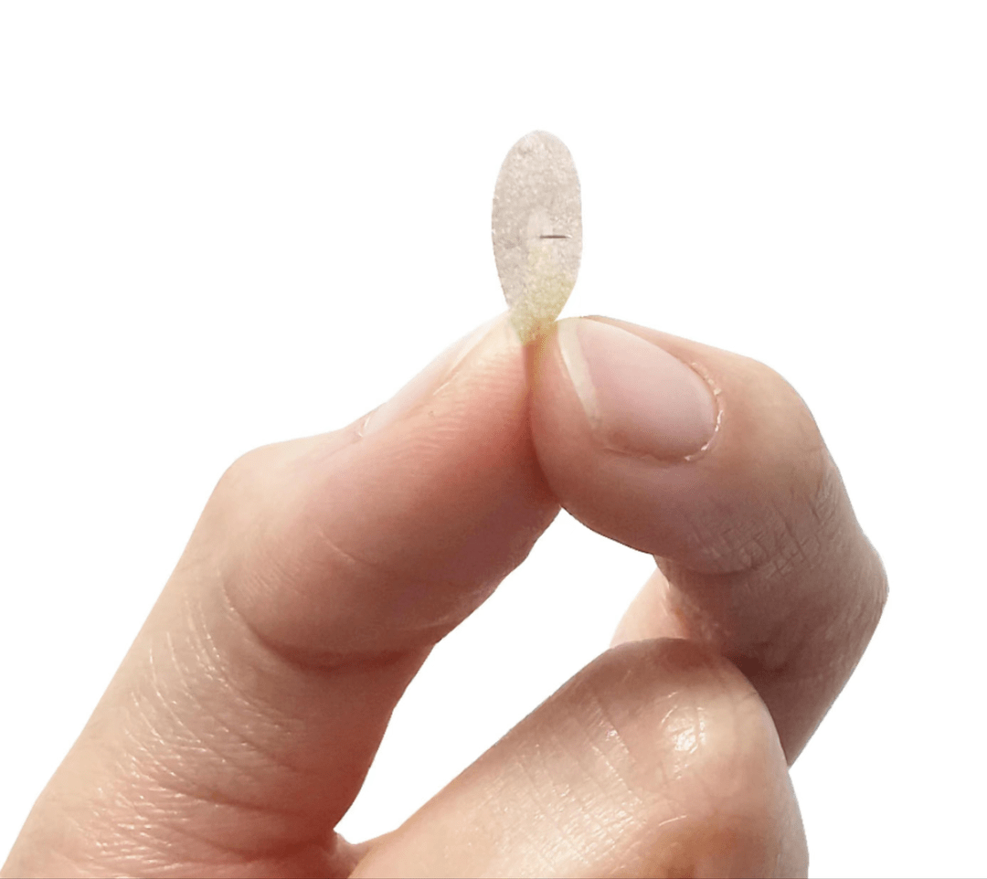 耳穴压豆,揿针辅助治疗:消化不良,慢性胃炎,神经衰弱,头痛,眩晕,失眠