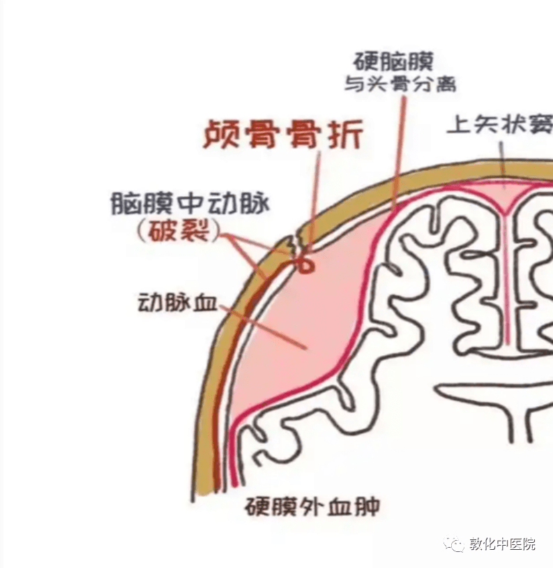 健康科普:如何应对脑挫裂伤_生命_患者_脑膜