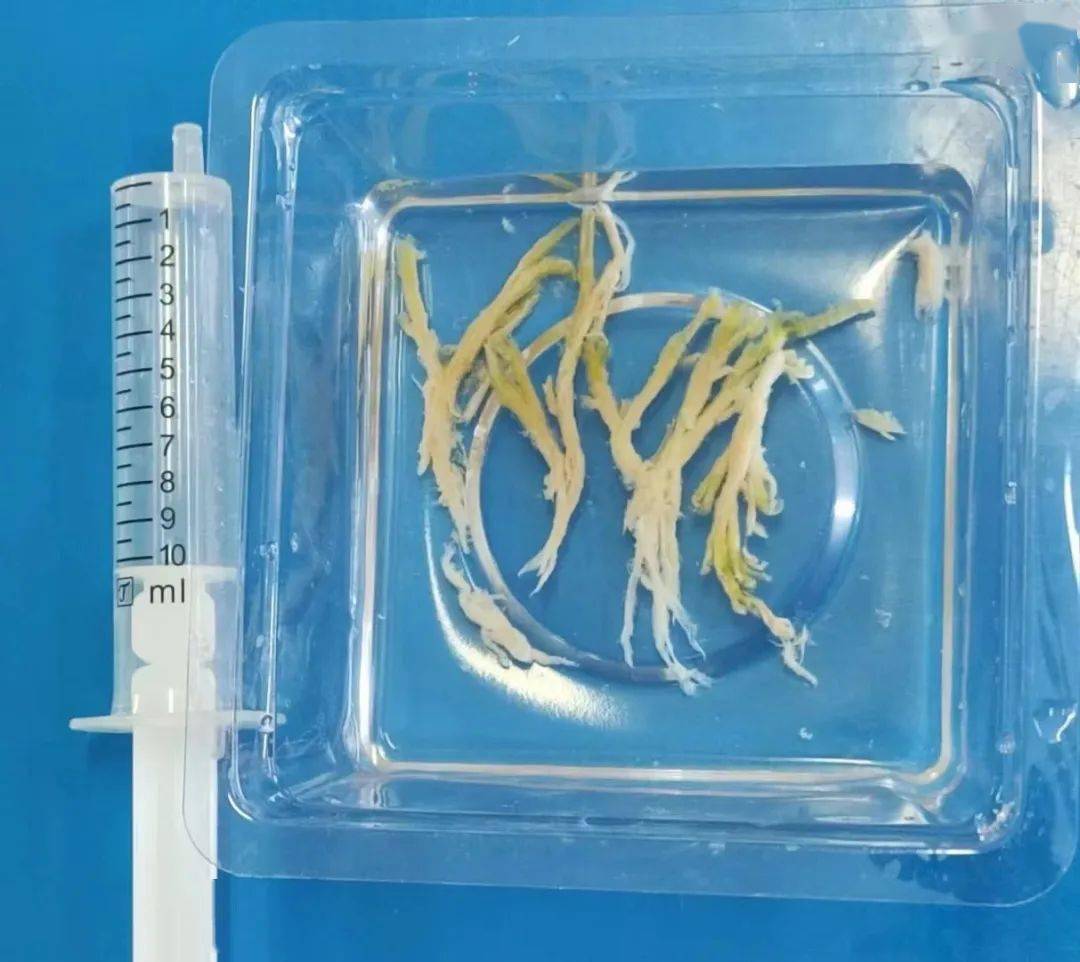 取出的痰栓就像一根根小树枝在顺利取出痰栓后,芃芃又在呼吸内科接受