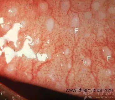 结膜炎滤泡图片图片