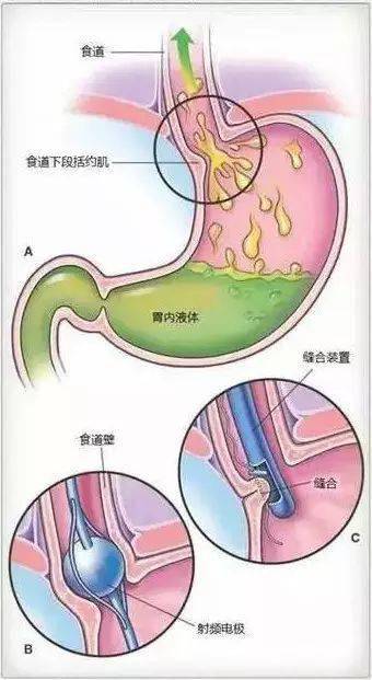 气管与胃管的结构图图片