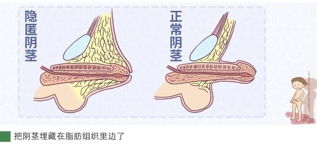 利用暑期,拯救深藏不露的"小鸟",让小丁丁"出人头地"_阴茎_隐匿性_手