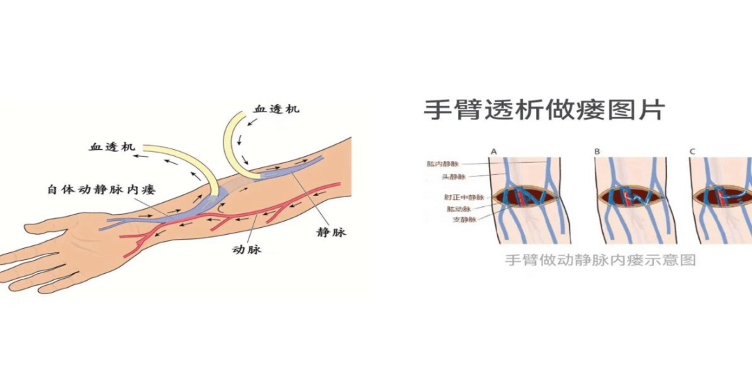 技术分享】以“管”造“桥”搭建透析生命线——晋江陈埭卫生院开展动静脉内瘘