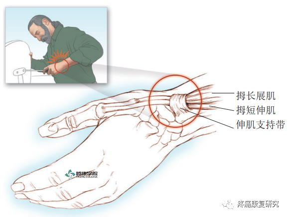 狭窄性腱鞘炎手术图解图片