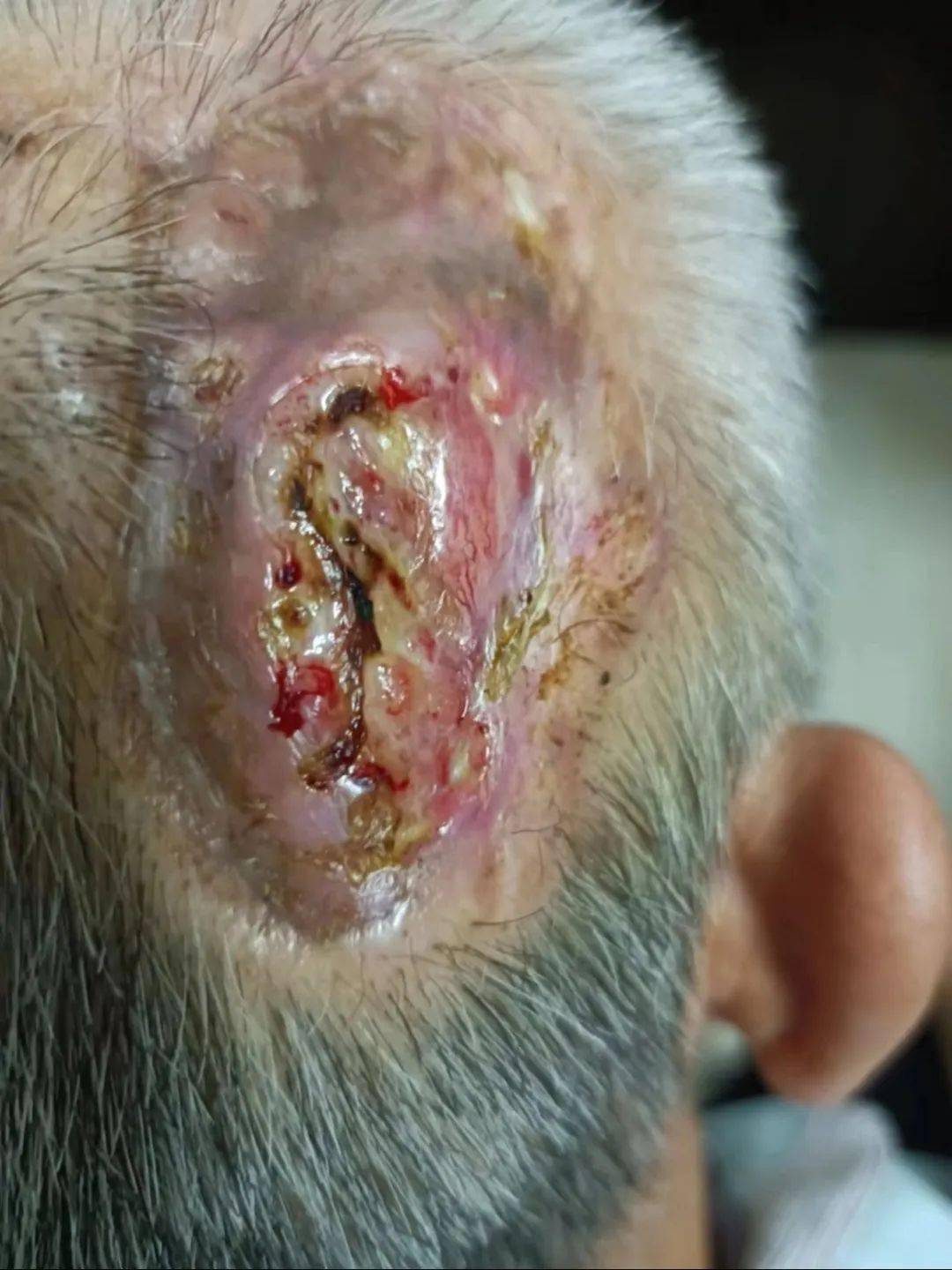 肇庆一院烧伤整形外科应用游离背阔肌肌皮瓣(ldmf)为患者修复头皮巨大