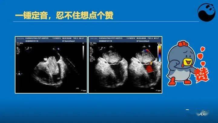 临床医生如何解读超声心动图报告_心脏_病例_患者