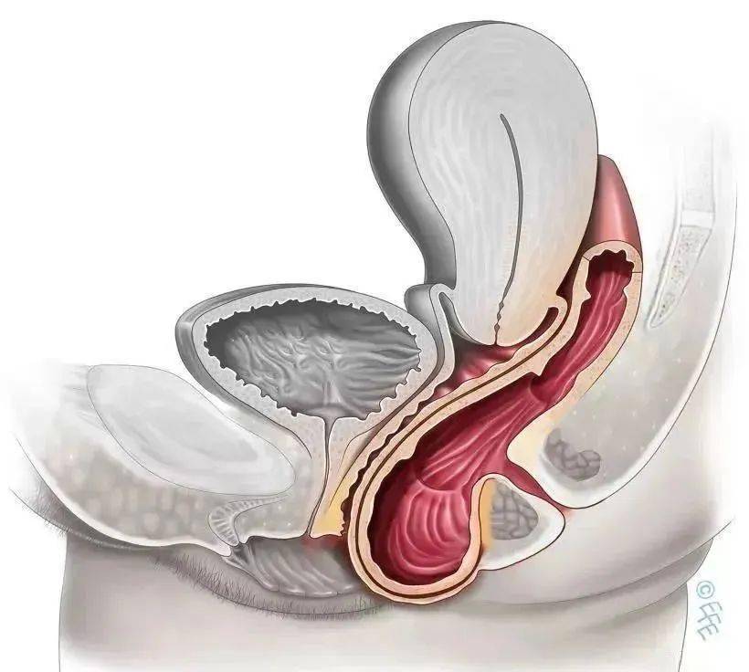 令人尴尬的秘密#漏尿=盆底肌松弛?别傻了,可能是阴道壁膨出找上你