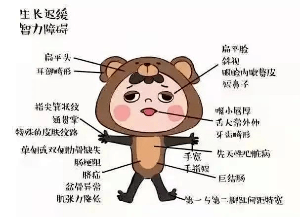 又称21一三体综合征,先天愚型,是由于21号染色体异常