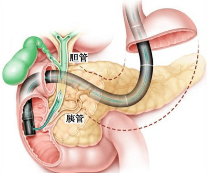 经内镜逆行性胰胆管造影术(ercp)是指将十二指肠镜插至十二指肠降部