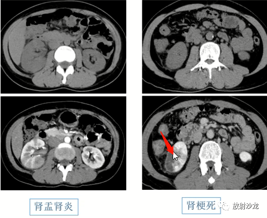 总结肾脏急性病变的影像诊断及鉴别_输尿管_病例_疾病