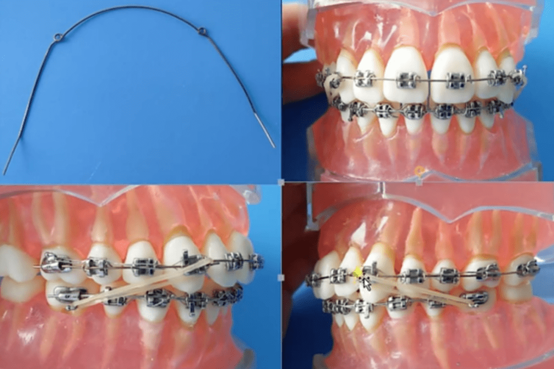 正畸皮筋牵引类型图片