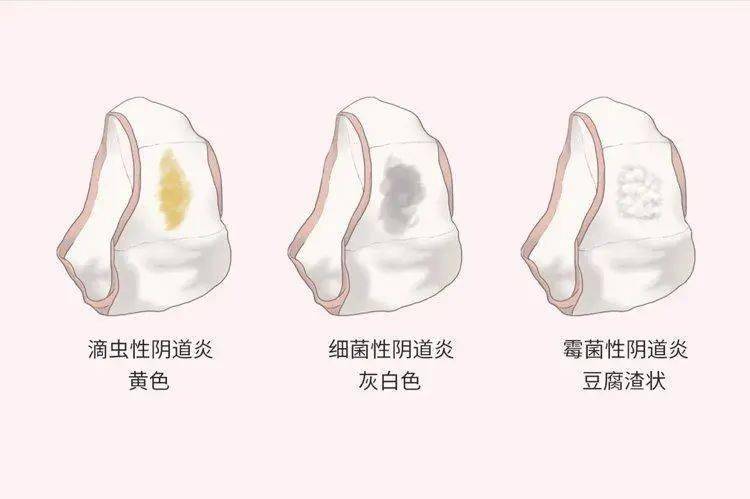 出乎意料_女性_阴道_老年