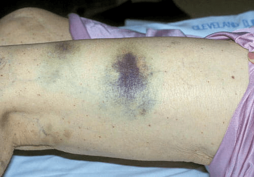 消化道出血,肺出血等,可因休克,呼吸衰竭,弥漫性血管内凝血(dic)等多