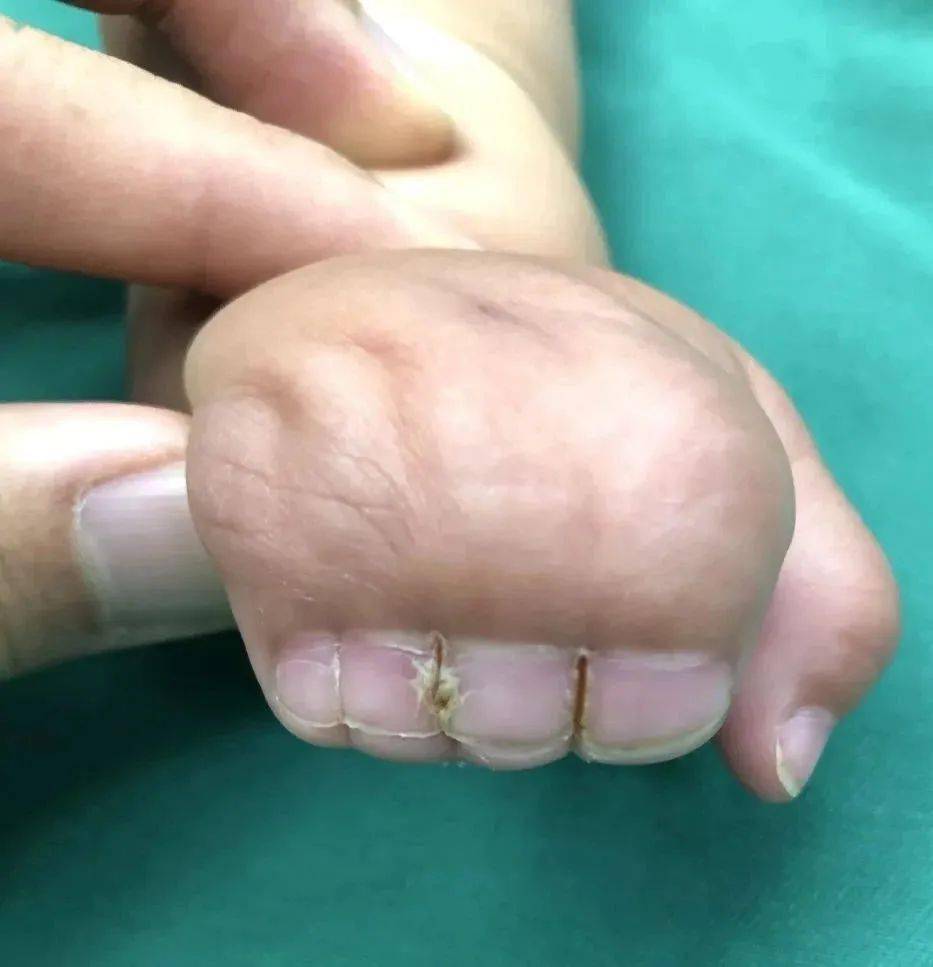 六指,也就是拇指畸形,临床上还有一种小儿手部常见的先天畸形——并