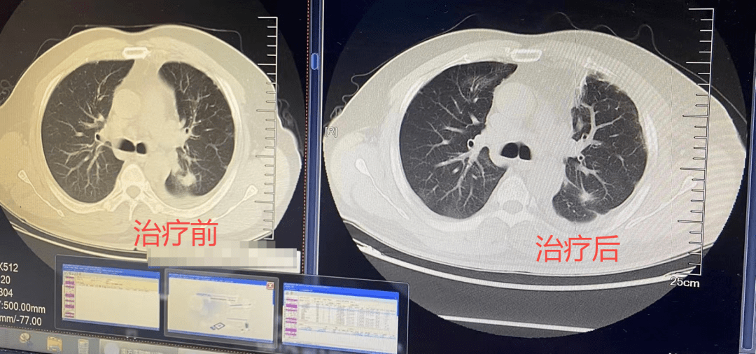 肺癌真实肿瘤图片大全图片