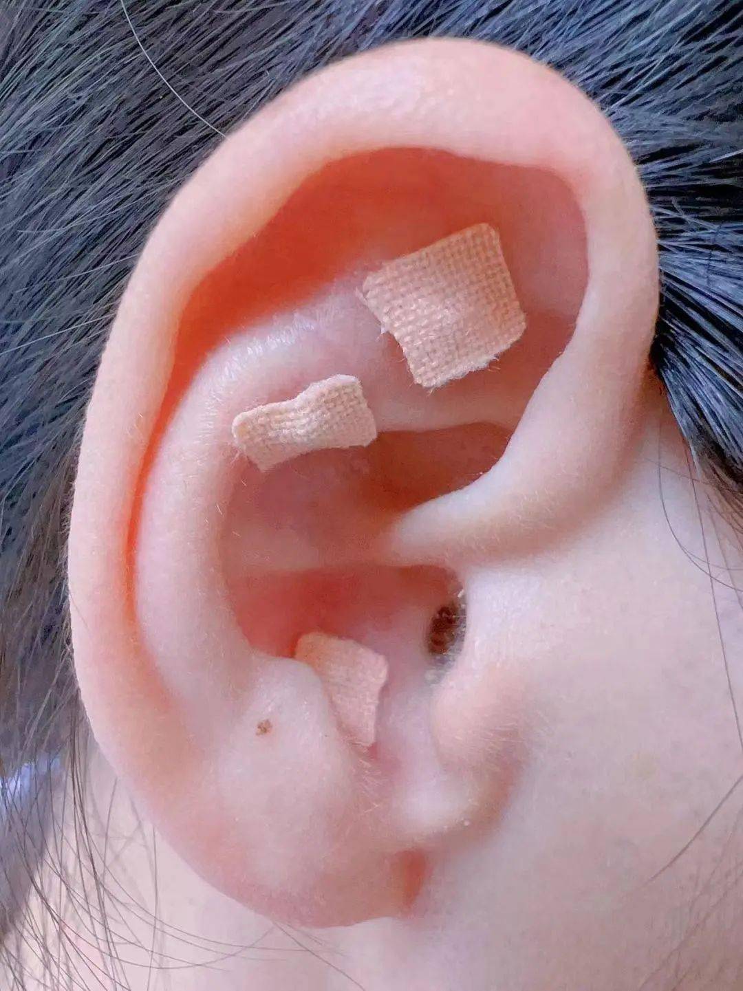 耳穴疗法是采用王不留行籽贴压刺激耳穴耳者宗脉之所聚也耳与