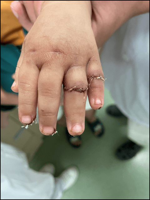 机器切断双指 深圳医生妙手再植》)(作者:深圳特区报首席记者 罗莉琼