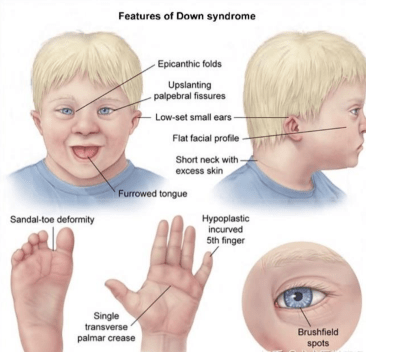 唐氏综合症图片 胎儿图片