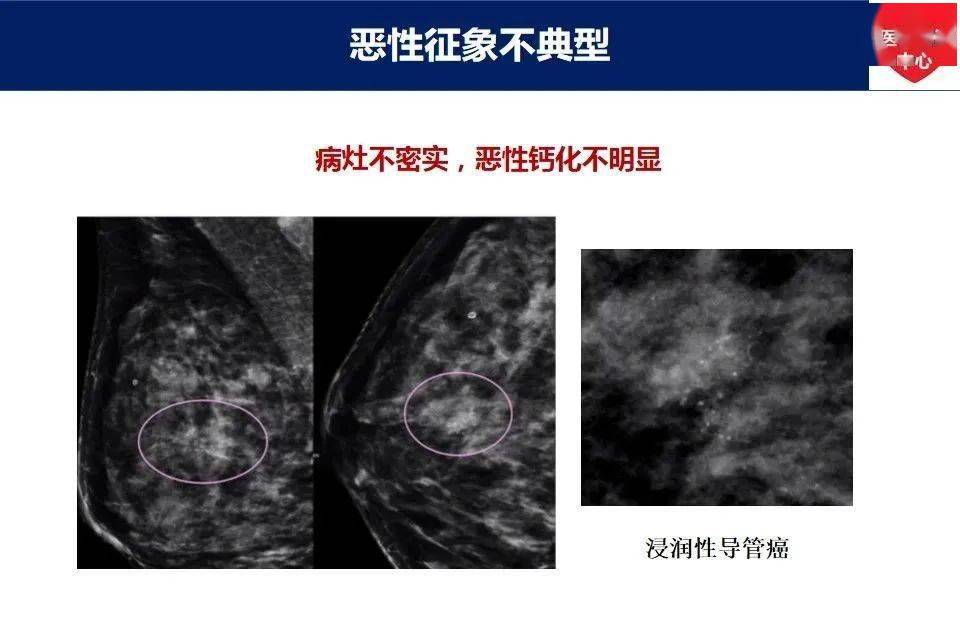 乳腺癌x线常见漏诊及误诊