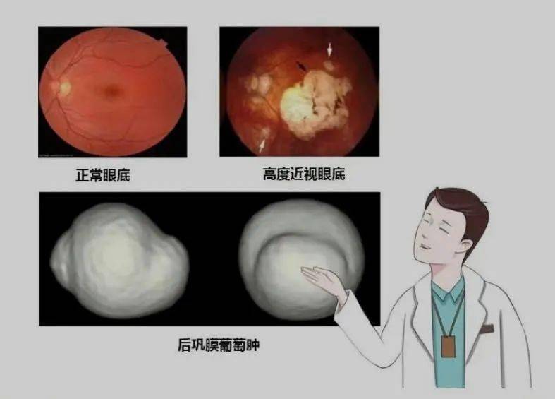 九,重视高度近视及相关并发症