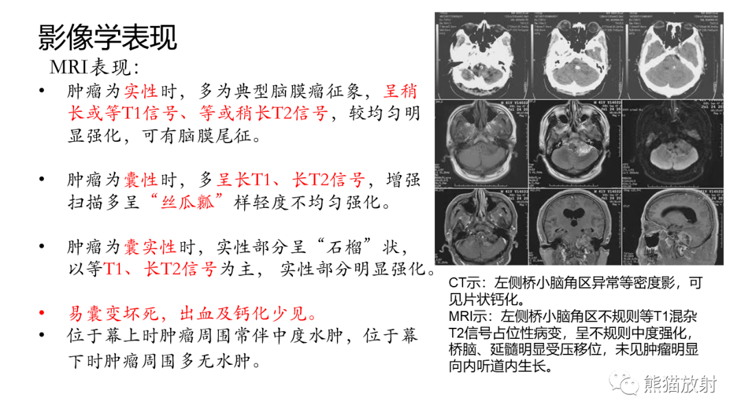 桥小脑角脂肪瘤图片