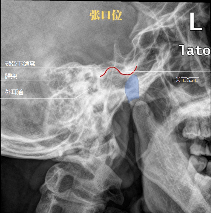 颞颌关节磨损图片