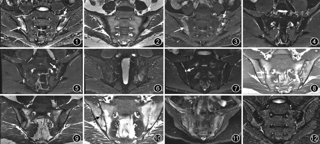  MRI ax SpA 
