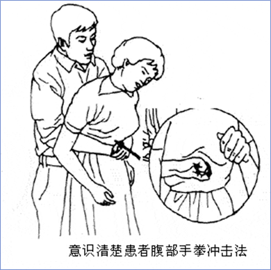 当出现气道异物梗阻的时候,普遍表现以下症状